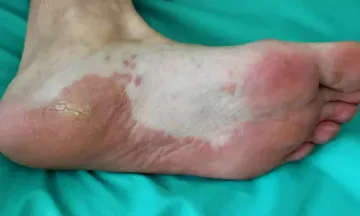 When to see a doctor for lichen planus?