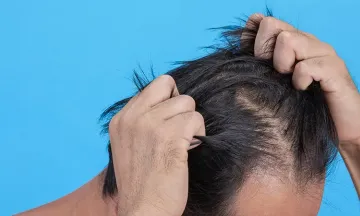 Homeopathy stops ‘hair pulling’ disorder effectively