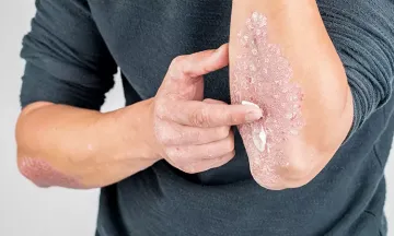 How effective are steroid creams for psoriasis?