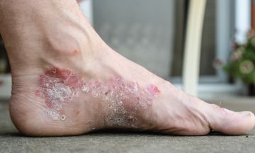 Psoriasis triggers that cause eruption