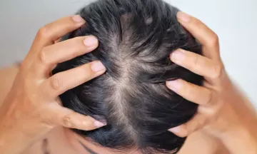 Solution for baldness in women