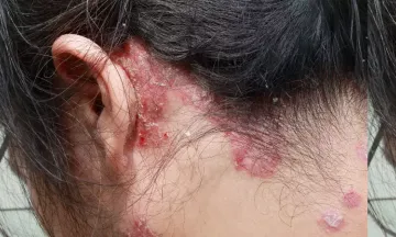 What does psoriasis look like on the scalp?