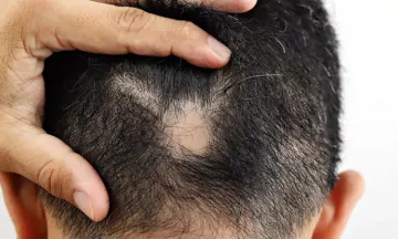 What causes bald spots?