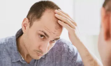 How To Treat Male Pattern Baldness?
