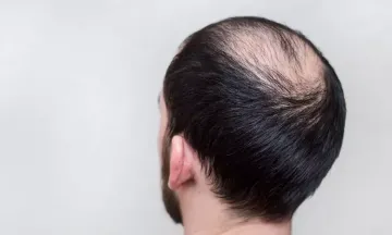 Is alopecia hereditary?