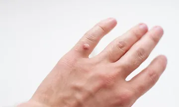 Tips to Manage Warts.