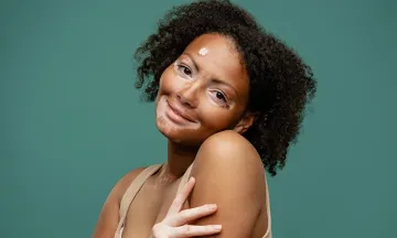 All that you wanted to know about Vitiligo