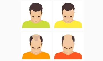 The best ways to combat a receding hairline