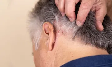Know the treatment options for scalp psoriasis