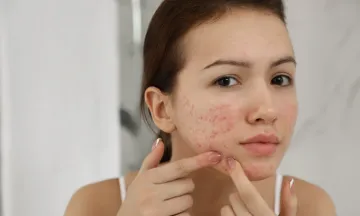 What is the best treatment for acne?