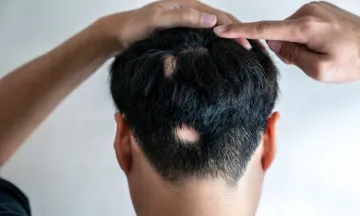 Alopecia Areata Causes - How to treat it with homeopathy?