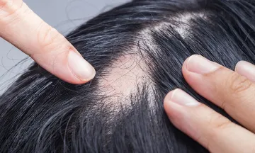 Can your hair grow back if you have alopecia?