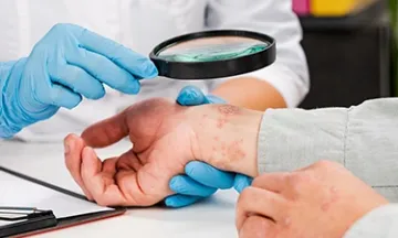 skin-diseases-eczema-symptoms