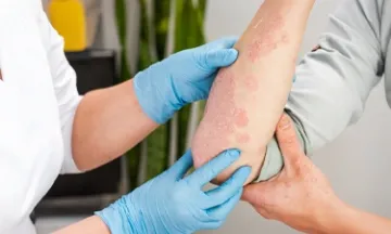 Types of Psoriasis: Understanding the Different Forms
