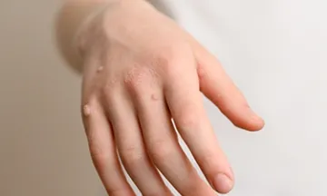 Types of Warts: Identification and Treatment