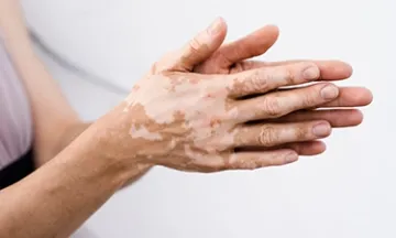 Vitiligo Causes: Why It Happens, What Triggers It & How to Control It