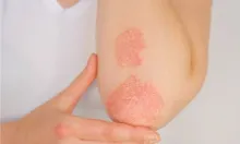Psoriasis Or Eczema - What’s The Difference?
