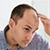 Male Pattern Baldness Causes icon