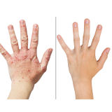 Eczema Treatment Results icon