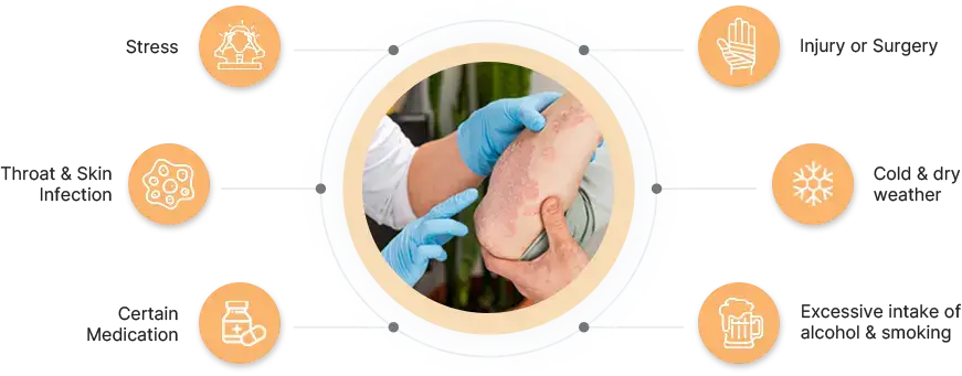 Causes of vitiligo