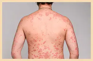 Erythrodermic Psoriasis