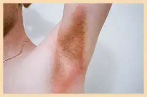 Inverse Psoriasis