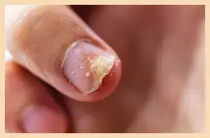 Nail Psoriasis