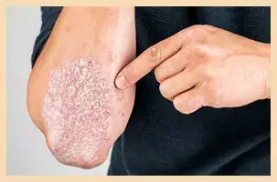 Plaque Psoriasis