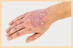 Plaque Psoriasis