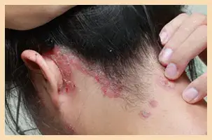 Scalp Psoriasis
