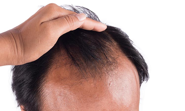 10 Things You Should Know About Male Hair Loss