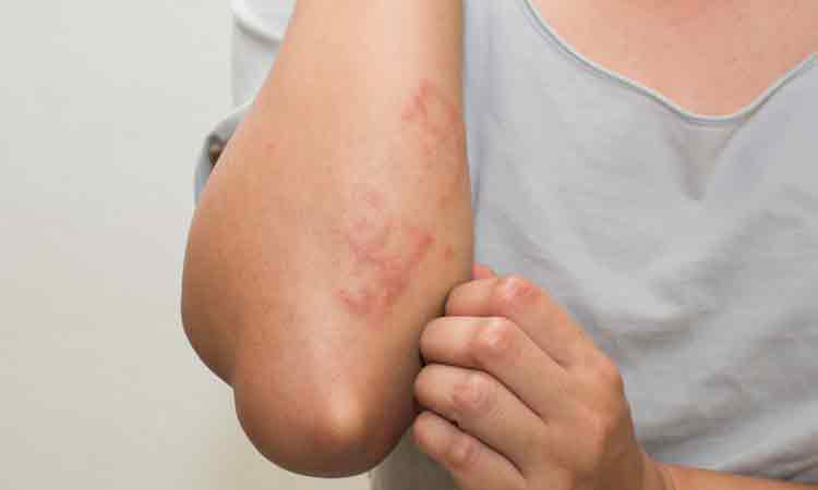 Watch Out for These Monsoon Skin Diseases Watch Out for These Monsoon Skin Diseases