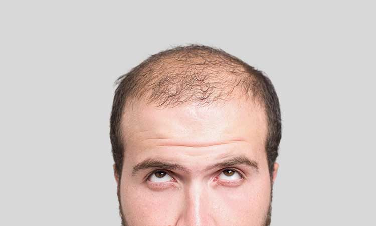 5 Common Causes Of Excessive Hairloss In Men Dr Batra S