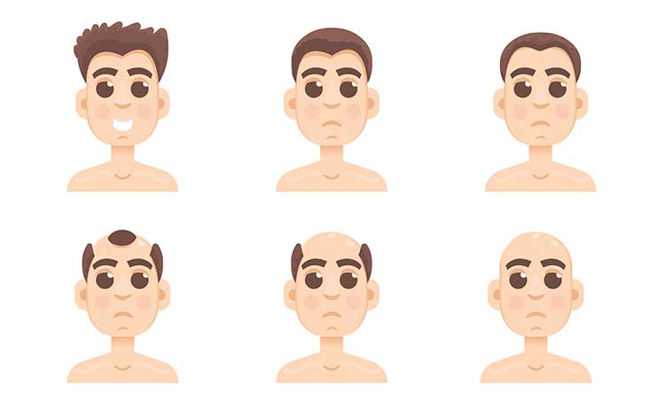 5 Early Warning Signs Of Balding