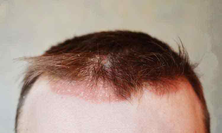 What I Wish Everyone Knew About Scalp Psoriasis And Homeopathy Dr