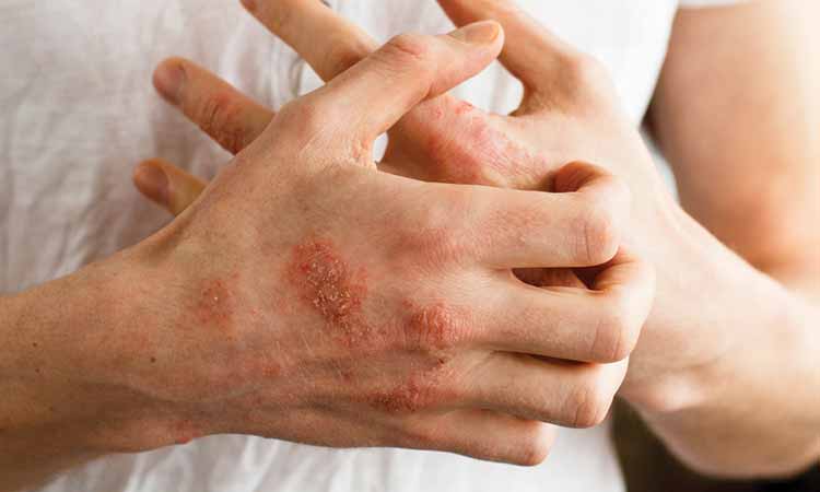 DOES ECZEMA FLARE UP IN SUMMER? CONTROL IT. DOES ECZEMA FLARE UP IN SUMMER? CONTROL IT.