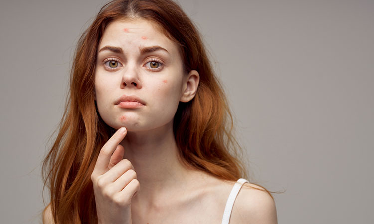 Does acne worsen in summer? Does acne worsen in summer?