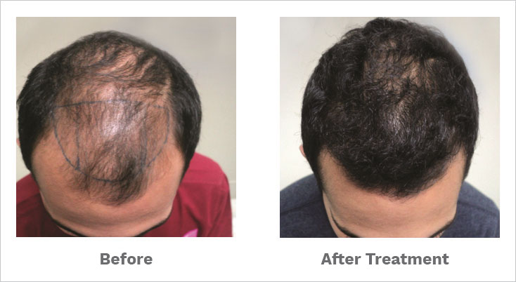 alopecia areata treated by our hair specialist- alopecia areata treated by our hair specialist-
