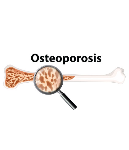 HOMEOPATHY & OSTEOPOROSIS