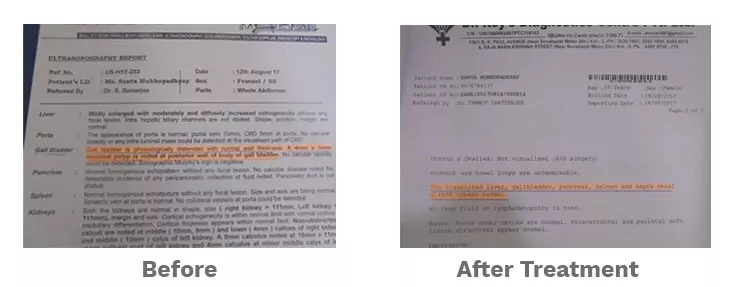 After homeopathic treatment, no stones were detected in the gallbladder. After homeopathic treatment, no stones were detected in the gallbladder.