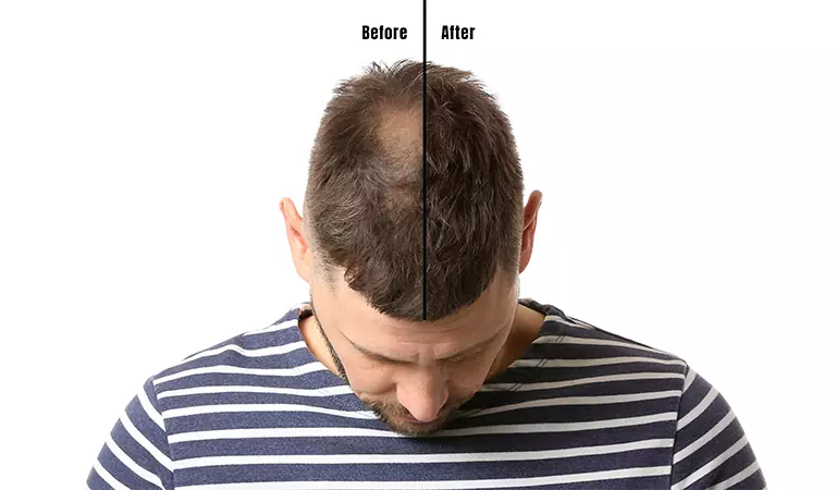 male pattern baldness