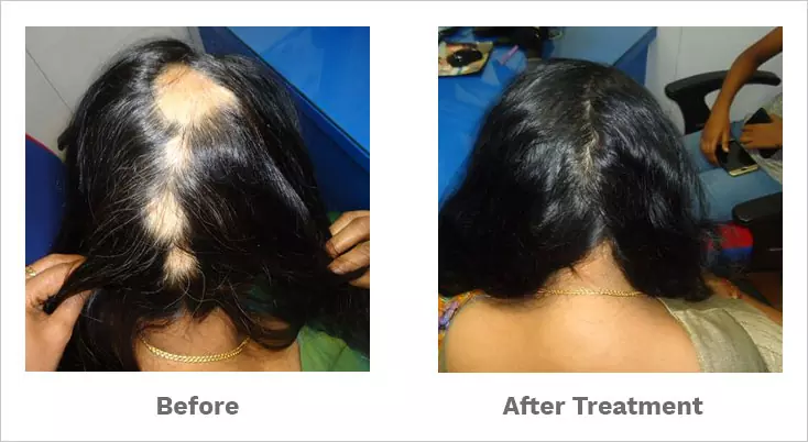 alopecia areata treated by our hair specialist-