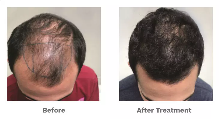 alopecia areata treated by our hair specialist-