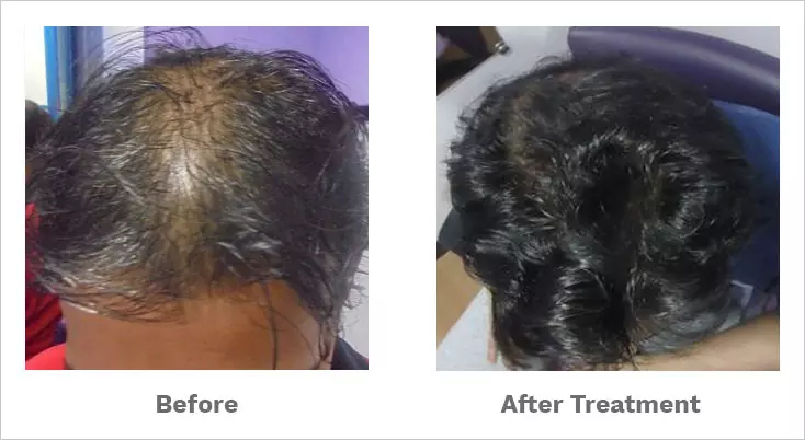 alopecia areata treated by our hair specialist-