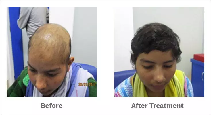 alopecia totalis treated by our hair specialist