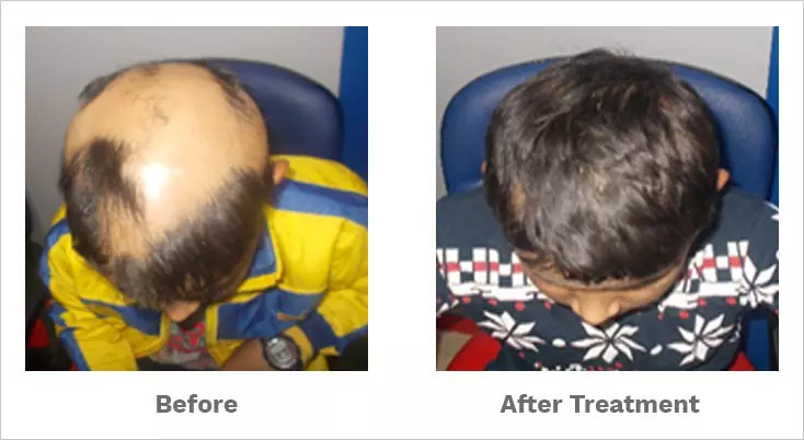 alopecia totalis treated by our hair specialist
