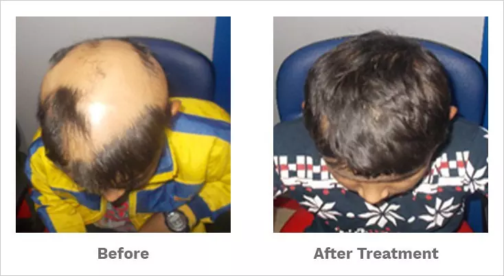 alopecia totalis treated by our hair specialist alopecia totalis treated by our hair specialist