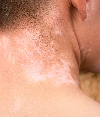 5 ways to stop vitiligo from spreading