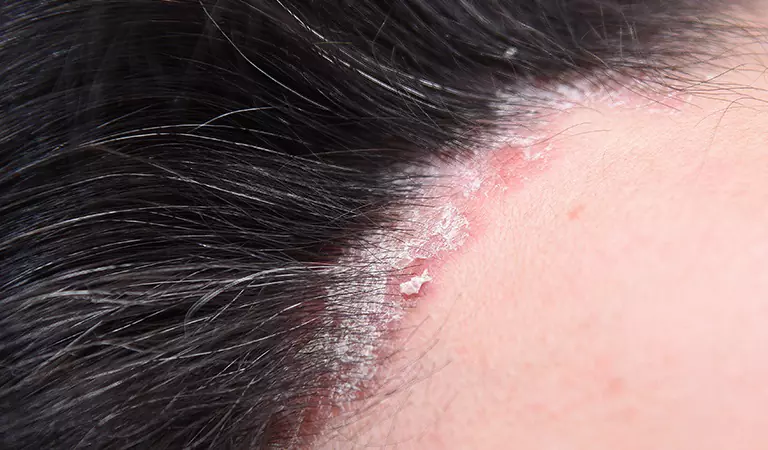 psoriasis