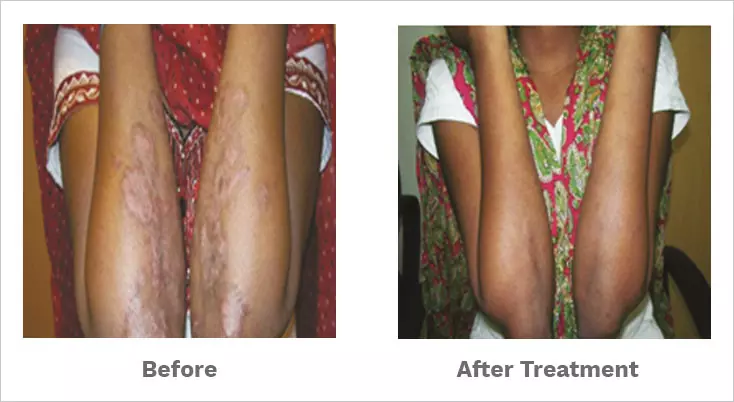 Psoriasis treatment in homeopathy at Dr Batra’s™